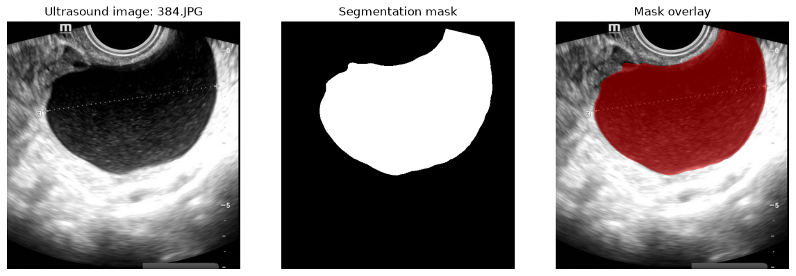 Example ultrasound image, segmentation mask and overlay